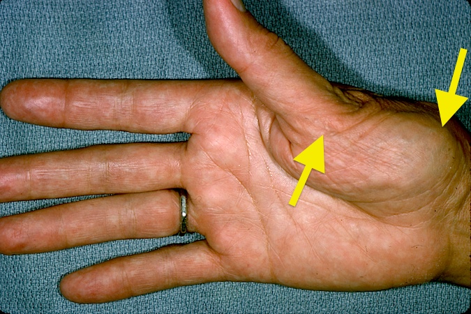 Osteoarthritis Carpometacarpal Cmc Joint Of Thumb Hand Surgery Source 9594